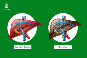 Vai trò của dinh dưỡng trong xơ gan